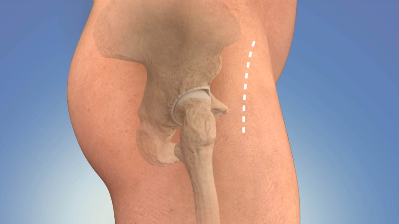 Hip implant anatomy illustration