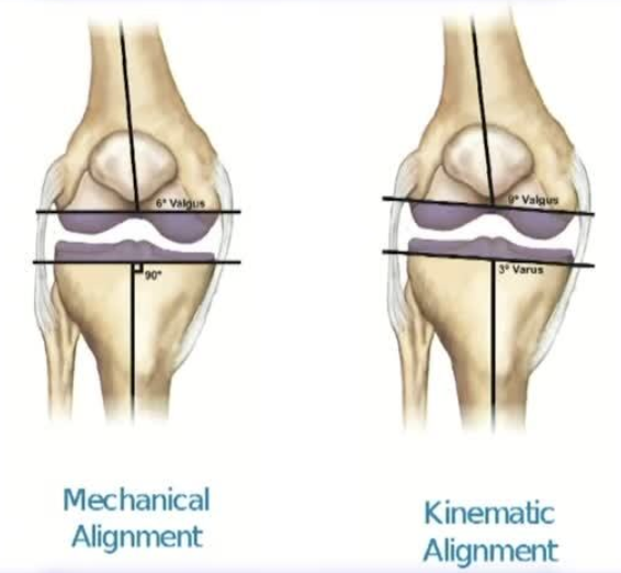 Knee alignment and joint surface illustration
